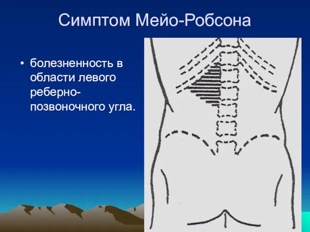 Симптом Мейо-Робсона болезненность в области левого реберно-позвоночного угла.