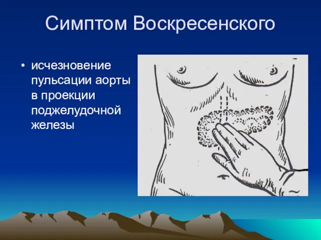 Симптом Воскресенского исчезновение пульсации аорты в проекции поджелудочной железы