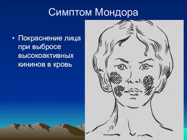 Симптом Мондора Покраснение лица при выбросе высокоактивных кининов в кровь