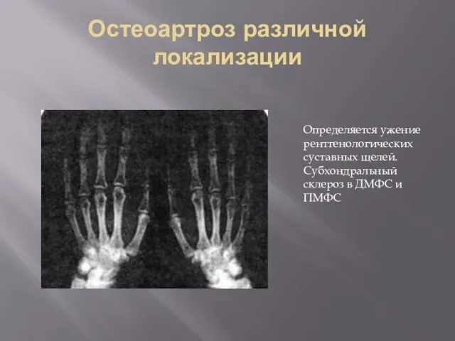 Остеоартроз различной локализации Определяется ужение рентгенологических суставных щелей. Субхондральный склероз в ДМФС и ПМФС