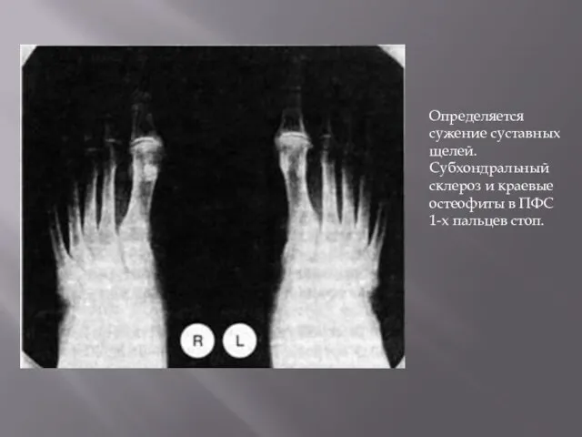 Определяется сужение суставных щелей. Субхондральный склероз и краевые остеофиты в ПФС 1-х пальцев стоп.