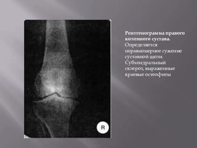 Рентгенограмма правого коленного сустава. Определяется неравномерное сужение суставной щели. Субхондральный склероз, выраженные краевые остеофиты