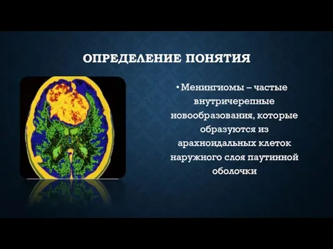 ОПРЕДЕЛЕНИЕ ПОНЯТИЯ Менингиомы – частые внутричерепные новообразования, которые образуются из арахноидальных клеток наружного слоя паутинной оболочки