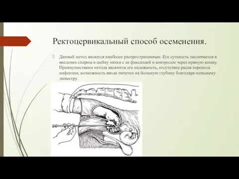 Ректоцервикальный способ осеменения. Данный метод является наиболее распространенным. Его сущность заключается в