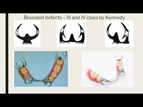 Bounded defects – III and IV class by Kennedy