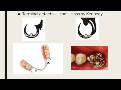 Terminal defects – I and II class by Kennedy