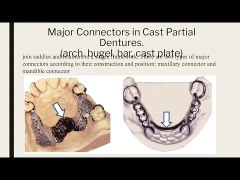 Major Connectors in Cast Partial Dentures. (arch, bugel, bar, cast plate) join