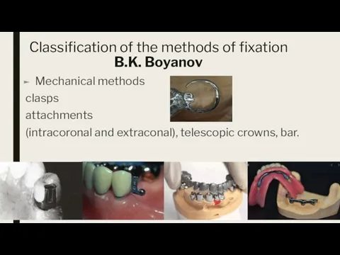 Classification of the methods of fixation B.K. Boyanov Mechanical methods clasps attachments