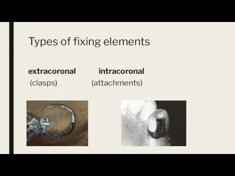 Types of fixing elements extracoronal intracoronal (clasps) (attachments)