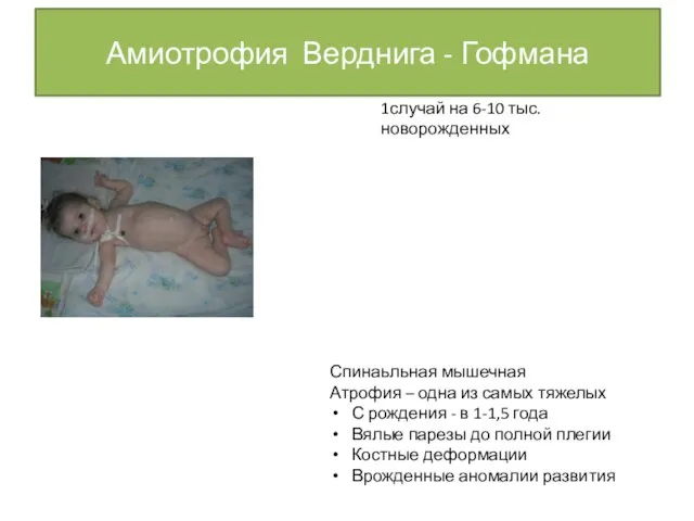 Амиотрофия Верднига - Гофмана 1случай на 6-10 тыс. новорожденных Спинаьльная мышечная Атрофия