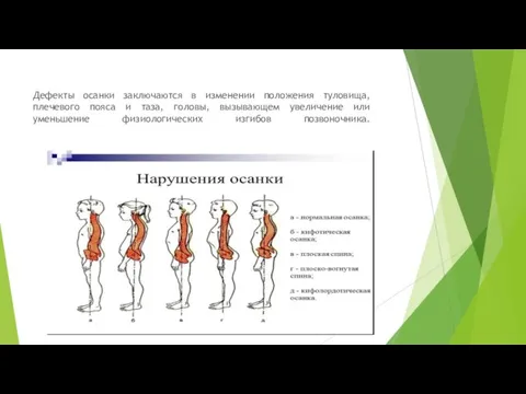 Дефекты осанки заключаются в изменении положения туловища, плечевого пояса и таза, головы,