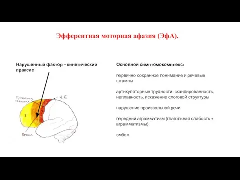 Эфферентная моторная афазия (ЭфА). Основной симптомокомплекс: первично сохранное понимание и речевые штампы