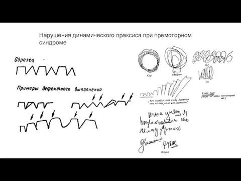 Нарушения динамического праксиса при премоторном синдроме