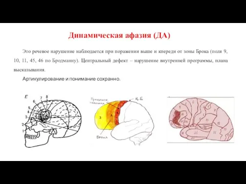 Это речевое нарушение наблюдается при поражении выше и кпереди от зоны Брока