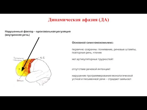 Динамическая афазия (ДА) Нарушенный фактор – произвольная регуляция (внутренняя речь) Основной симптомокомплекс: