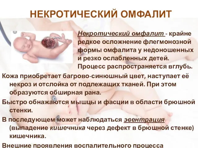 НЕКРОТИЧЕСКИЙ ОМФАЛИТ Некротический омфалит - крайне редкое осложнение флегмонозной формы омфалита у