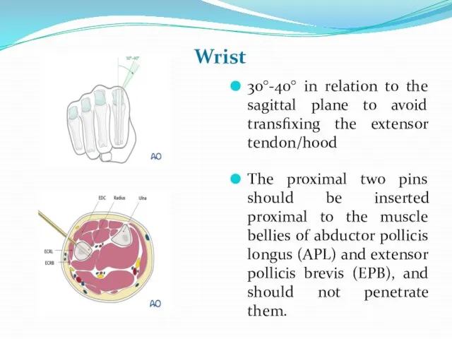 Wrist 30°-40° in relation to the sagittal plane to avoid transfixing the