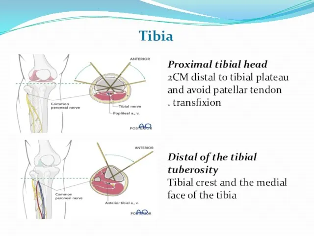 Tibia Proximal tibial head 2CM distal to tibial plateau and avoid patellar