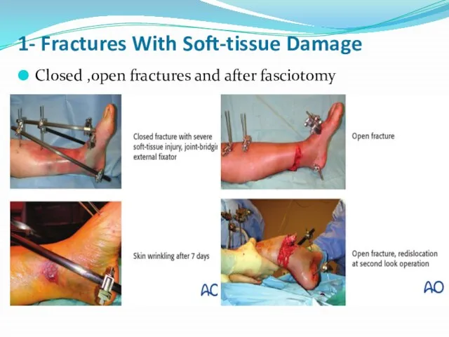 1- Fractures With Soft-tissue Damage Closed ,open fractures and after fasciotomy