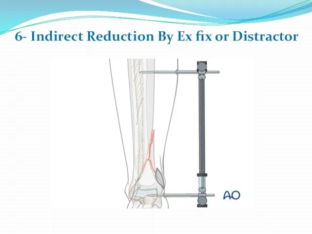 6- Indirect Reduction By Ex fix or Distractor