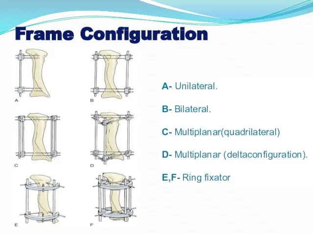 Frame Configuration A- Unilateral. B- Bilateral. C- Multiplanar(quadrilateral) D- Multiplanar (deltaconfiguration). E,F- Ring fixator