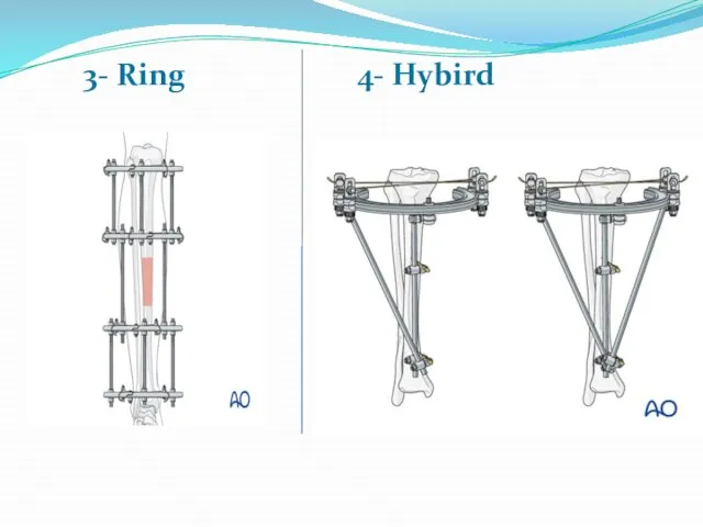 3- Ring 4- Hybird