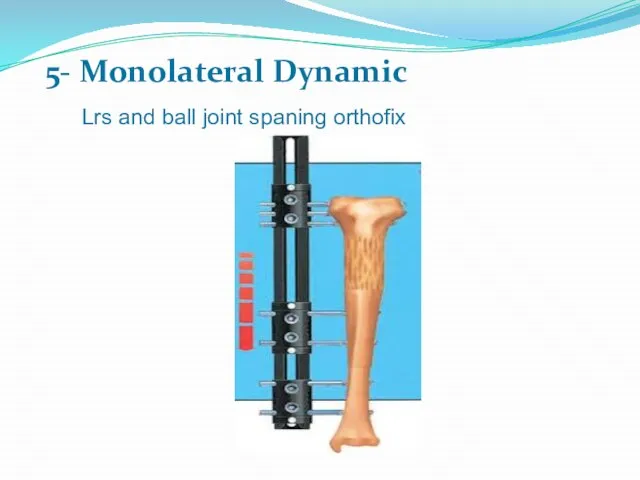 5- Monolateral Dynamic Lrs and ball joint spaning orthofix