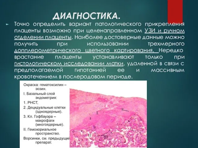 ДИАГНОСТИКА. Точно определить вариант патологического прикрепления плаценты возможно при целенаправленном УЗИ и