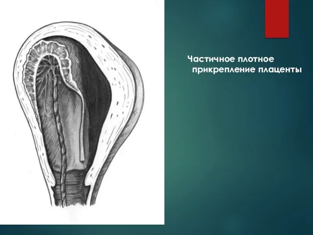 Частичное плотное прикрепление плаценты