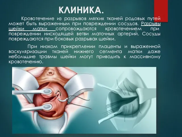 КЛИНИКА. Кровотечение из разрывов мягких тканей родовых путей может быть выраженным при