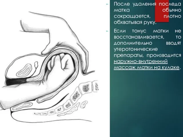 После удаления последа матка обычно сокращается, плотно обхватывая руку. Если тонус матки