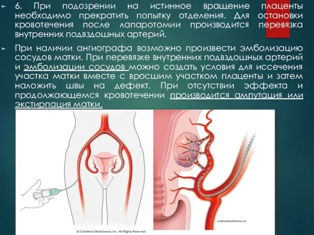 6. При подозрении на истинное вращение плаценты необходимо прекратить попытку отделения. Для