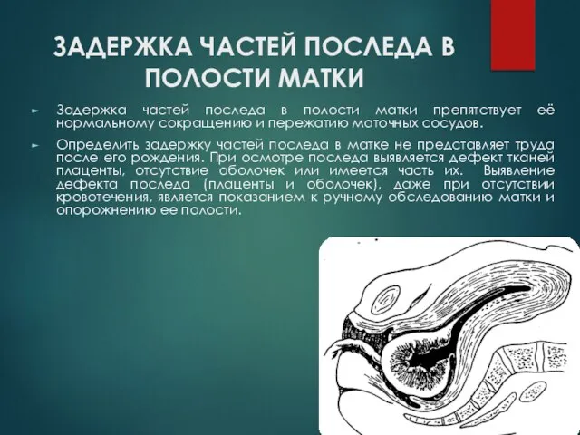 ЗАДЕРЖКА ЧАСТЕЙ ПОСЛЕДА В ПОЛОСТИ МАТКИ Задержка частей последа в полости матки