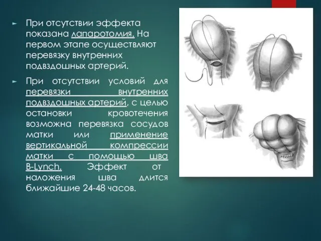 При отсутствии эффекта показана лапаротомия. На первом этапе осуществляют перевязку внутренних подвздошных