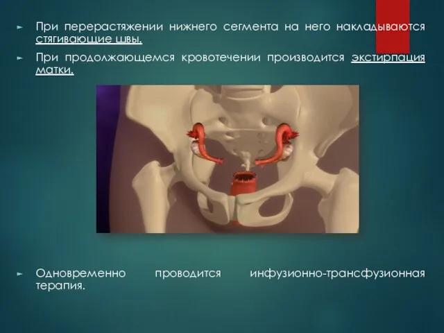 При перерастяжении нижнего сегмента на него накладываются стягивающие швы. При продолжающемся кровотечении