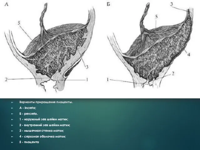 Варианты приращения плаценты. А - increta; Б - percreta. 1 - наружный