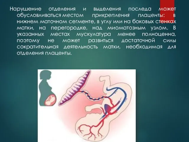 Нарушение отделения и выделения последа может обусловливаться местом прикрепления плаценты: в нижнем