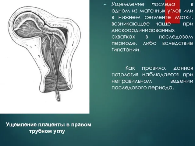 Ущемление последа в одном из маточных углов или в нижнем сегменте матки,