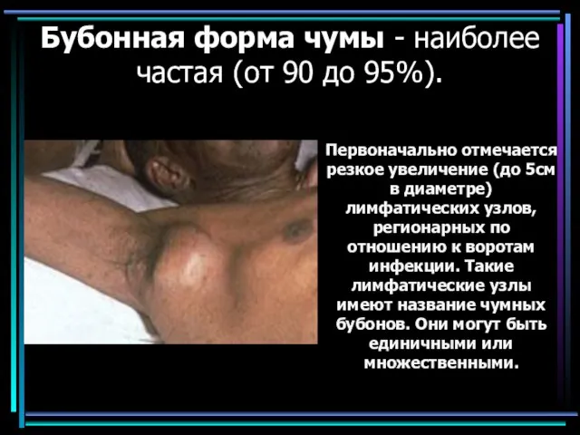 Бубонная форма чумы - наиболее частая (от 90 до 95%). Первоначально отмечается