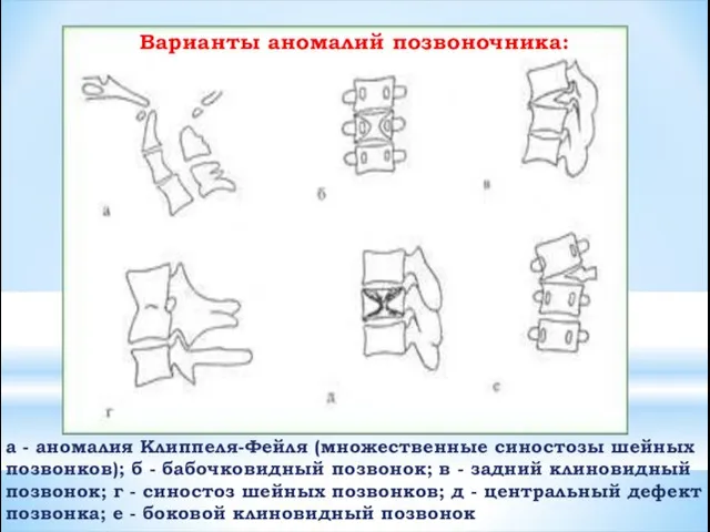 а - аномалия Клиппеля-Фейля (множественные синостозы шейных позвонков); б - бабочковидный позвонок;