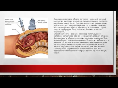 Еще одним методом аборта является – солевой, который состоит из введения в