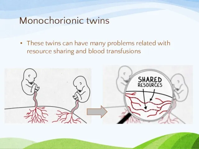 Monochorionic twins These twins can have many problems related with resource sharing and blood transfusions