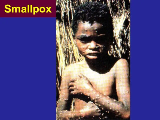 Smallpox