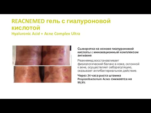 REACNEMED гель с гиалуроновой кислотой Hyaluronic Acid + Acne Complex Ultra Сыворотка