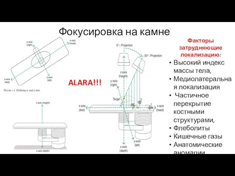 Фокусировка на камне Факторы затрудняющие локализацию: Высокий индекс массы тела, Медиолатеральная локализация