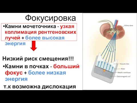 Фокусировка Камни мочеточника - узкая коллимация рентгеновских лучей + более высокая энергия