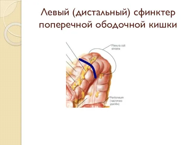 Левый (дистальный) сфинктер поперечной ободочной кишки