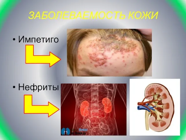 ЗАБОЛЕВАЕМОСТЬ КОЖИ Импетиго Нефриты