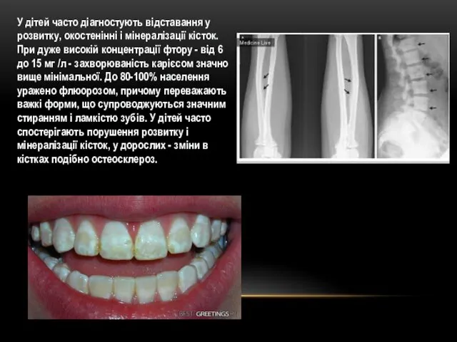 У дітей часто діагностують відставання у розвитку, окостенінні і мінералізації кісток. При