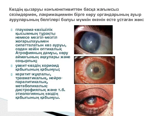 глаукома-көзішілік қысымның тұрақты немесе мезгіл-мезгіл жоғарылауымен сипатталатын көз ауруы, содан кейін оптикалық